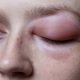 Angioedema allergic swelling