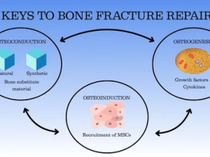 Bone Grafts and Substitutes in Fracture Repair – Part 2